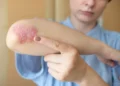 Cum poate fi diagnosticarea Eczemei (dermatitei atopice)